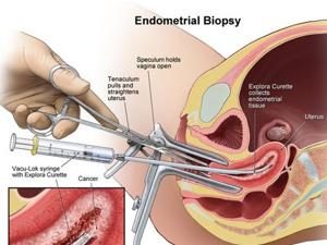 Endometrial Biopsy Procedure